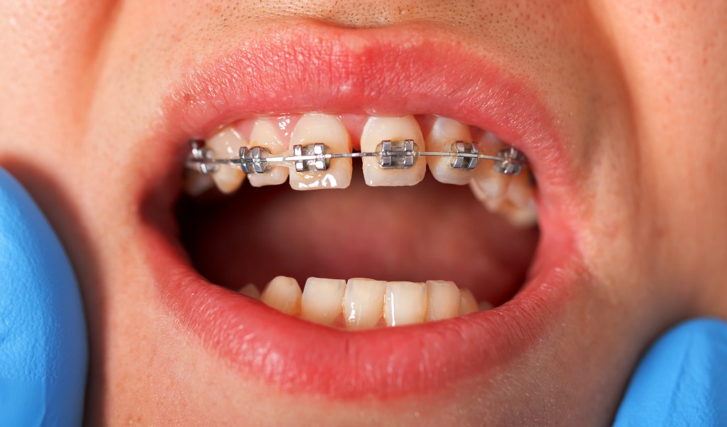 ارتودنسی و درمان فاصله دندانی 