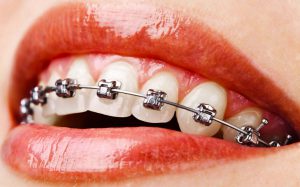 ارتودنسی روی دندان 
