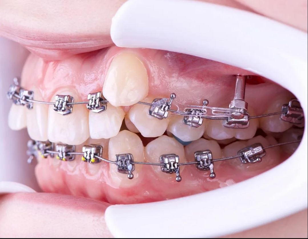 ارتودنسی و درمان دندان نیش نهفته