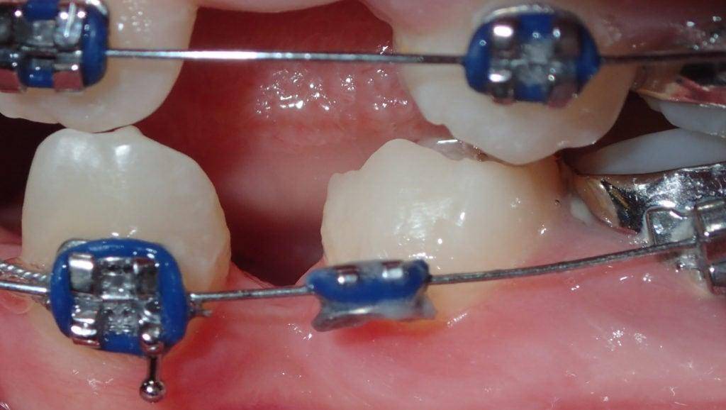 ارتودنسی و درمان دندانهای غایب 