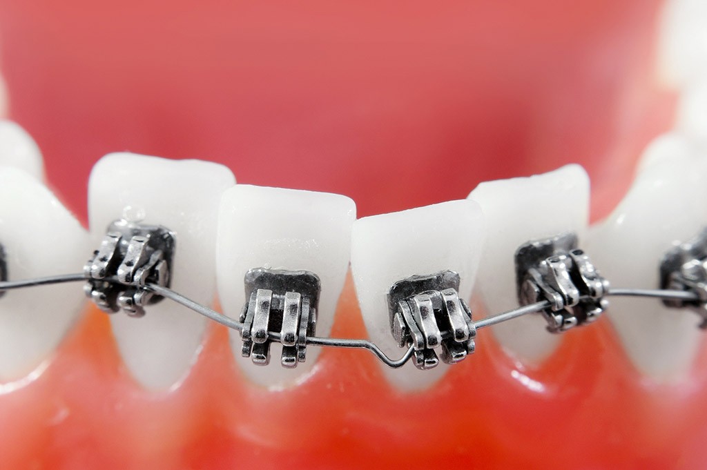به هم ریختگی دندان و ارتودنسی 