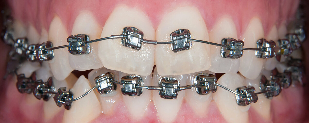 شلوغی دندان ها و درمان با ارتودنسی 